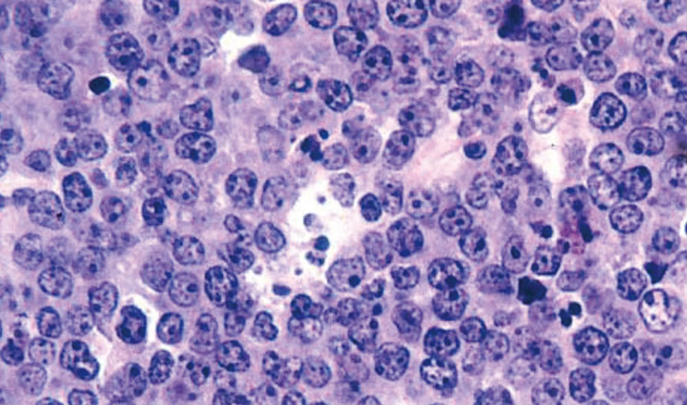 Lymphoma cells.