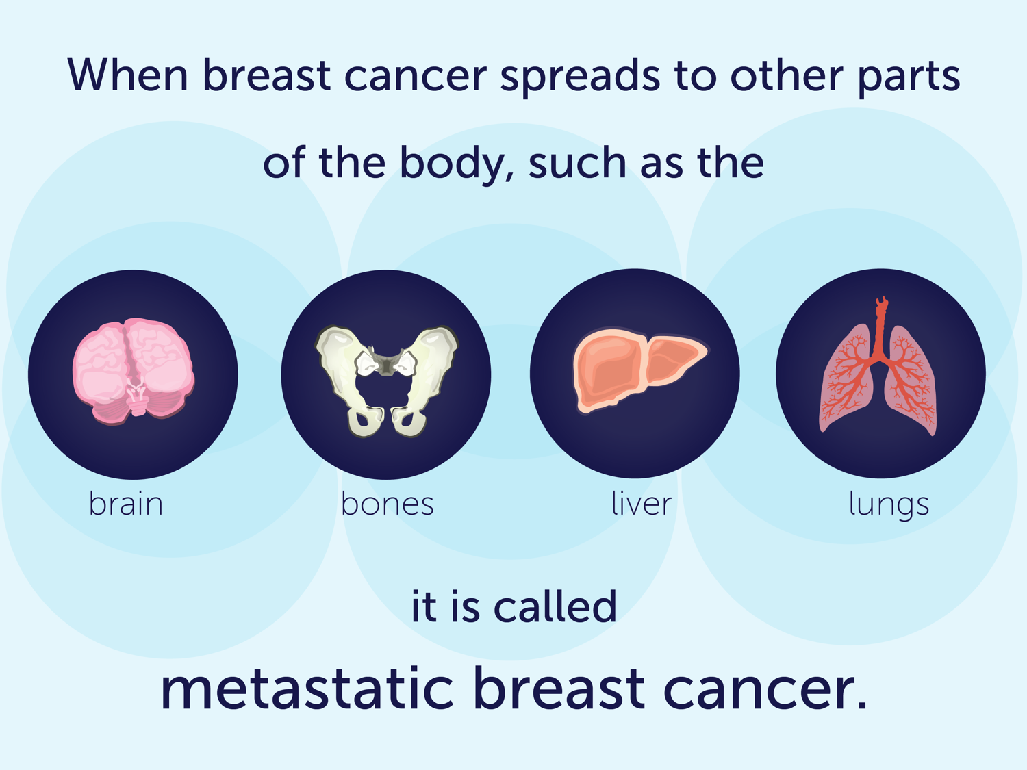 stages of metastatic breast cancer