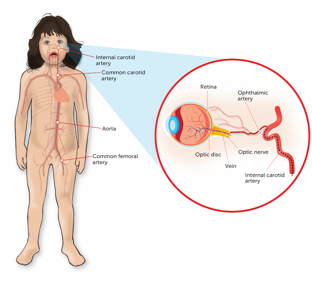 An illustration of intra-arterial chemotherapy for retinoblastoma.