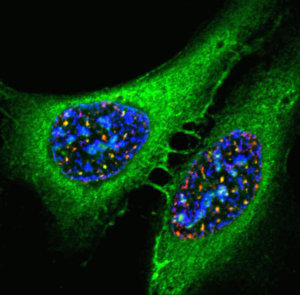 Osteosarcoma cells. Source: Dr. Lance Liotta Laboratory