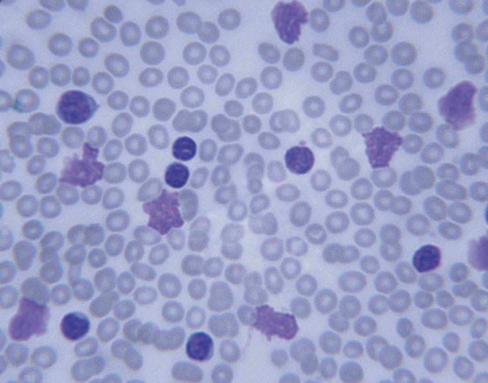 An image of leukemia cells. For people with CHIP, risk of developing a blood cancer such as leukemia is 10 times higher than average.