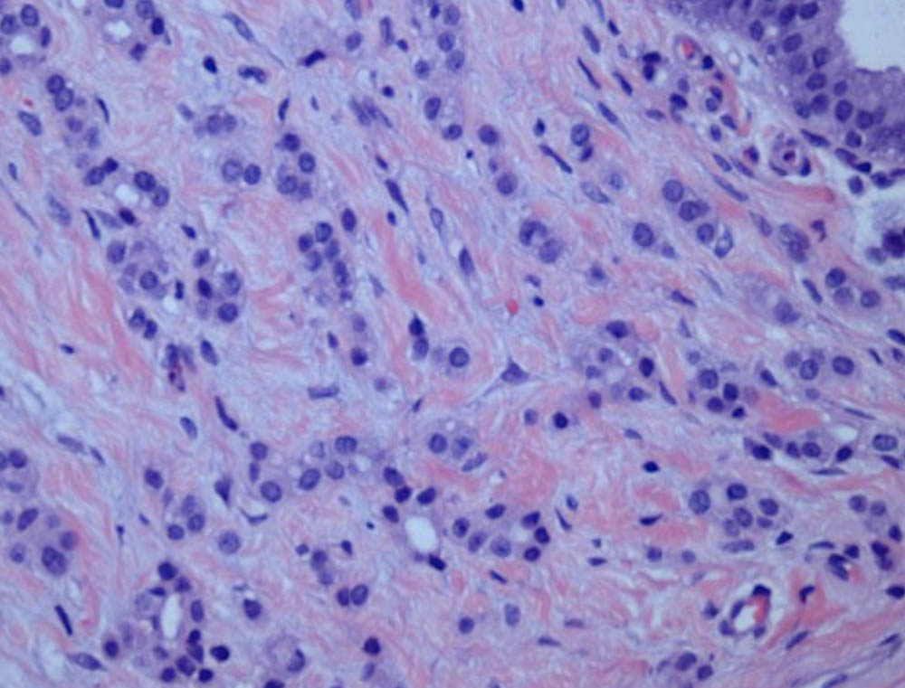Profil genetic de baza de evaluare risc cancer sân/ovar ereditar