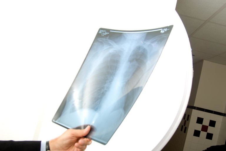 Can XRays Cause Cancer? DanaFarber Cancer Institute