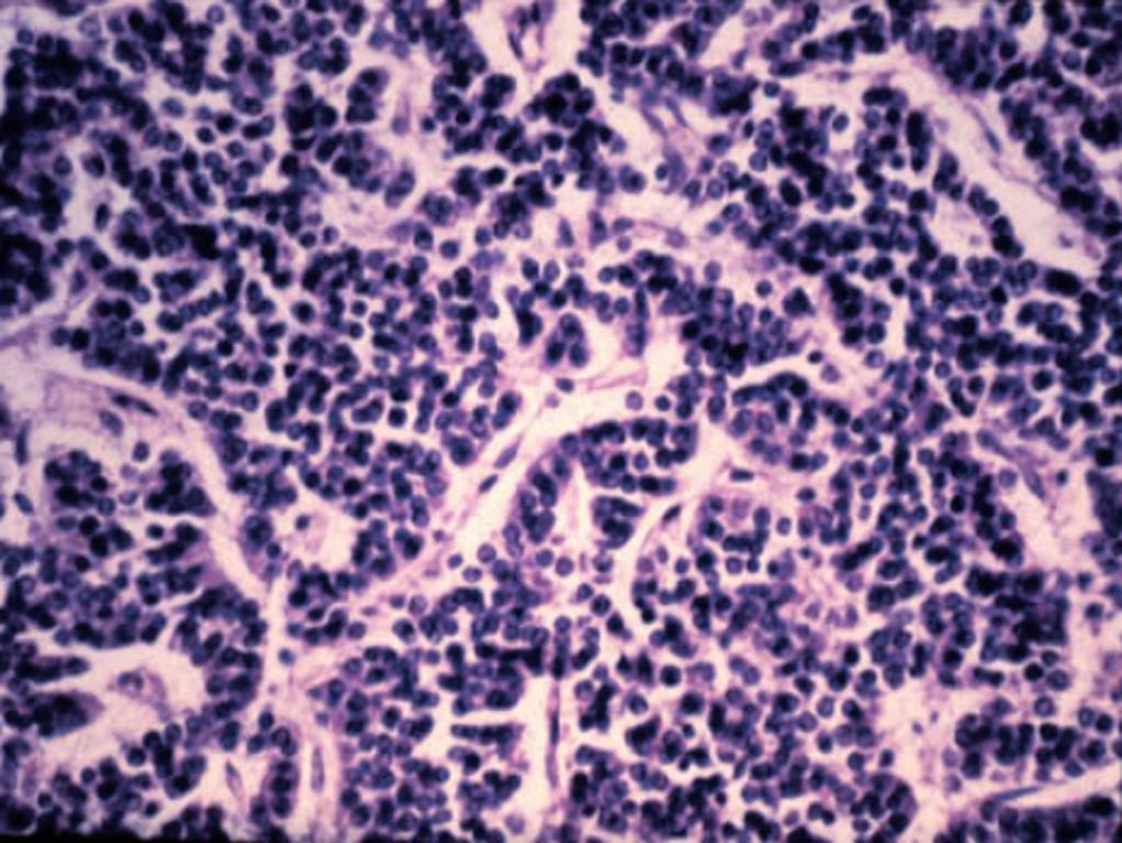 carcinoid tumor cells