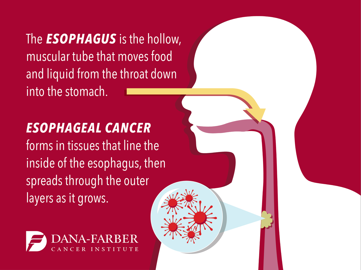 Famosos con cancer de esofago