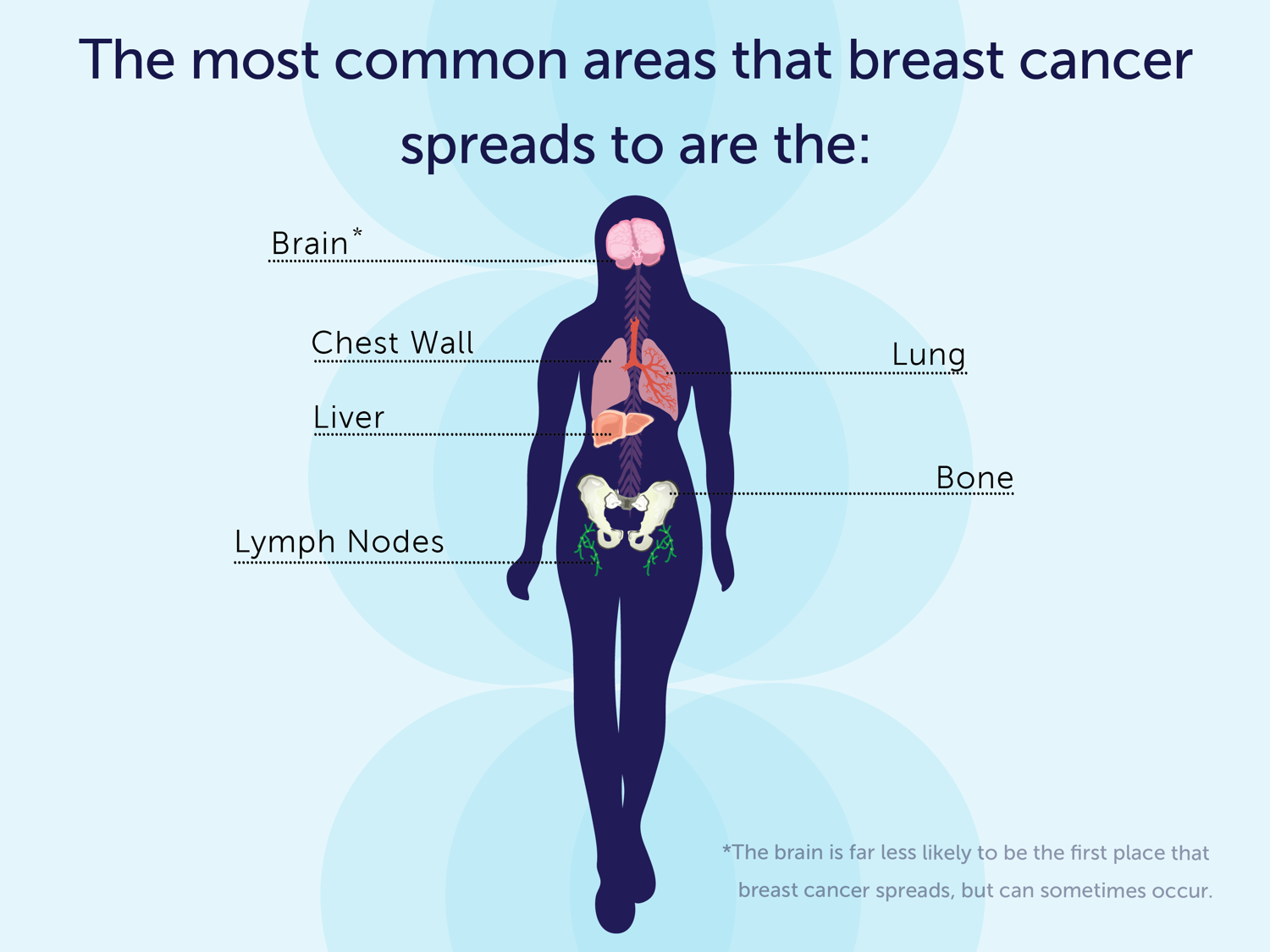 What Are The First Signs Of Metastatic Breast Cancer Stage 3 Iii A B And C National Breast