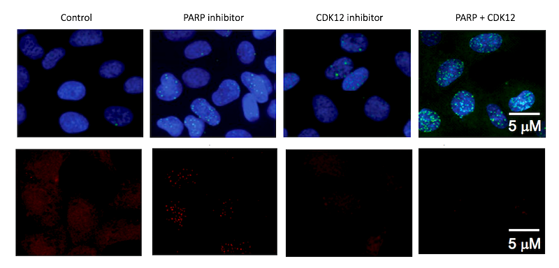 Fluorescent staining shows how PARP and CDK12 inhibitors combine to deal a lethal blow to Ewing sarcoma. In the top row, green represents locations of DNA damage incurred by Ewing sarcoma cells. In the bottom row, red represents DNA repair activity. Together, PARP and CDK12 inhibitors lead to Ewing sarcoma cell death.