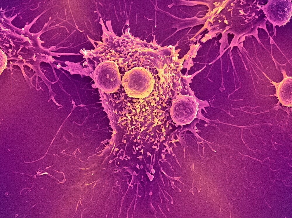 T lymphocyte cells (smaller round cells) attached to a cancer cell. T lymphocytes are a type of white blood cell and one of the components of the body's immune system. 