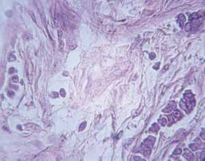 Carcinoma cells.