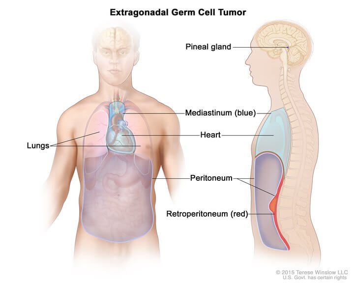 parts of the body where extragonadal germ cell tumors may form, including the pineal gland in the brain, the mediastinum (the area between the lungs), and the retroperitoneum (the area behind the abdominal organs). Source: National Cancer Institute.