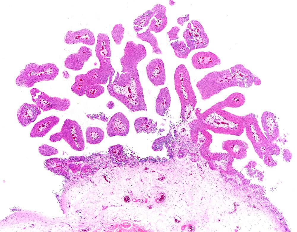 Bladder cancer cells.