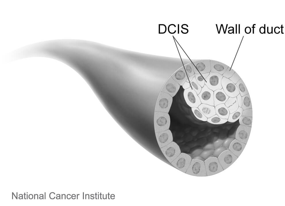 A breast duct with ductal carcinoma in situ (DCIS).
