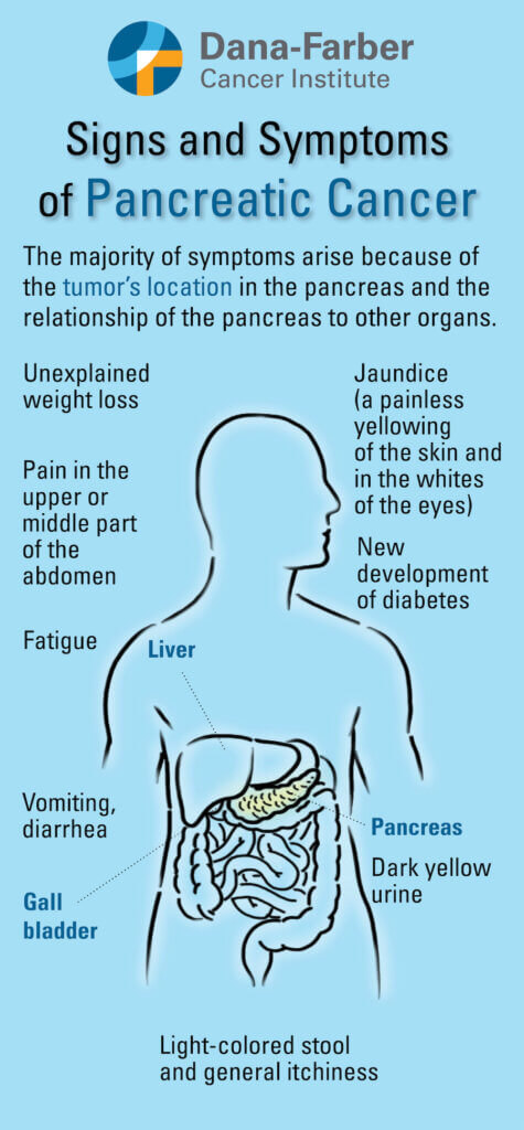 Symptoms of pancreatic cancer. 