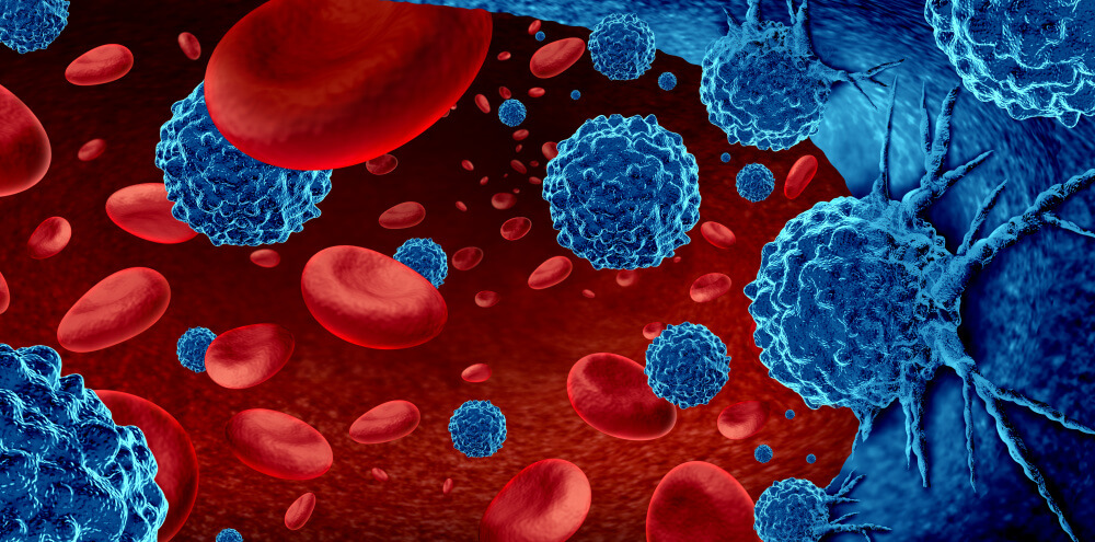 Hemoglobin is an essential protein in your red blood cells. Anemia is essentially a blood condition marked by a low level of hemoglobin and red blood cells. Physicians aim to treat the anemia to help patients regain normal hemoglobin levels. What types of cancer cause low hemoglobin?  Low hemoglobin in some cases can be an indication of Leukemia  and lymphoma. 
