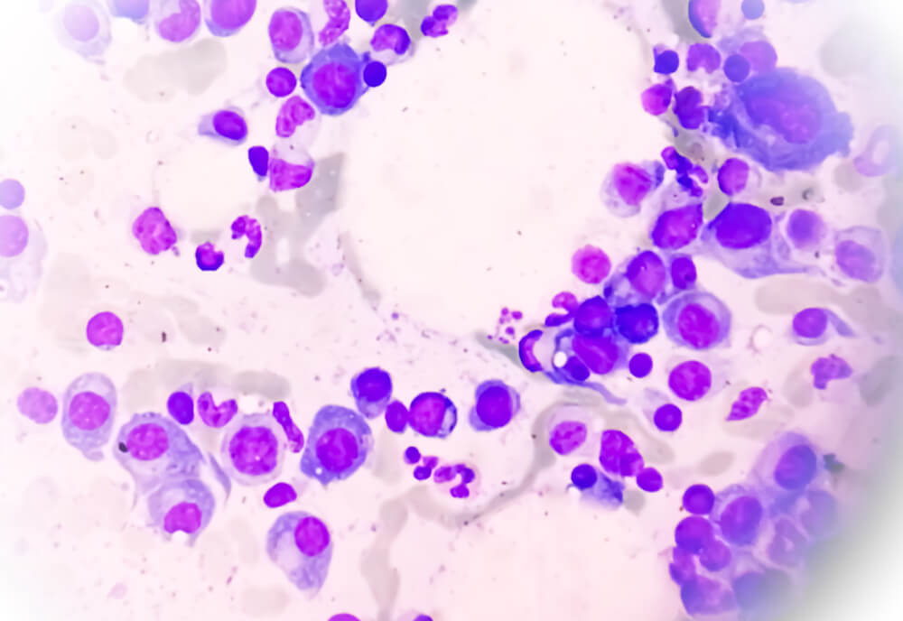 A microscopic view of bone marrow slide showing multiple myeloma cells.